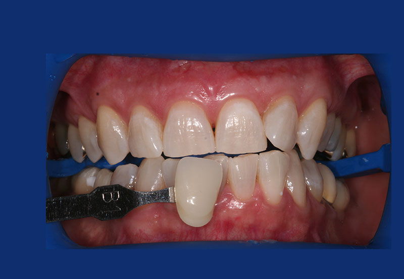 Nahaufnahme von Zähnen nach einem Bleaching