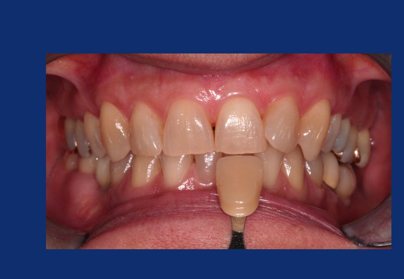 Nahaufnahme von Zähnen vor einem Bleaching mit